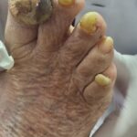 fenestracion y desbridacion laminas